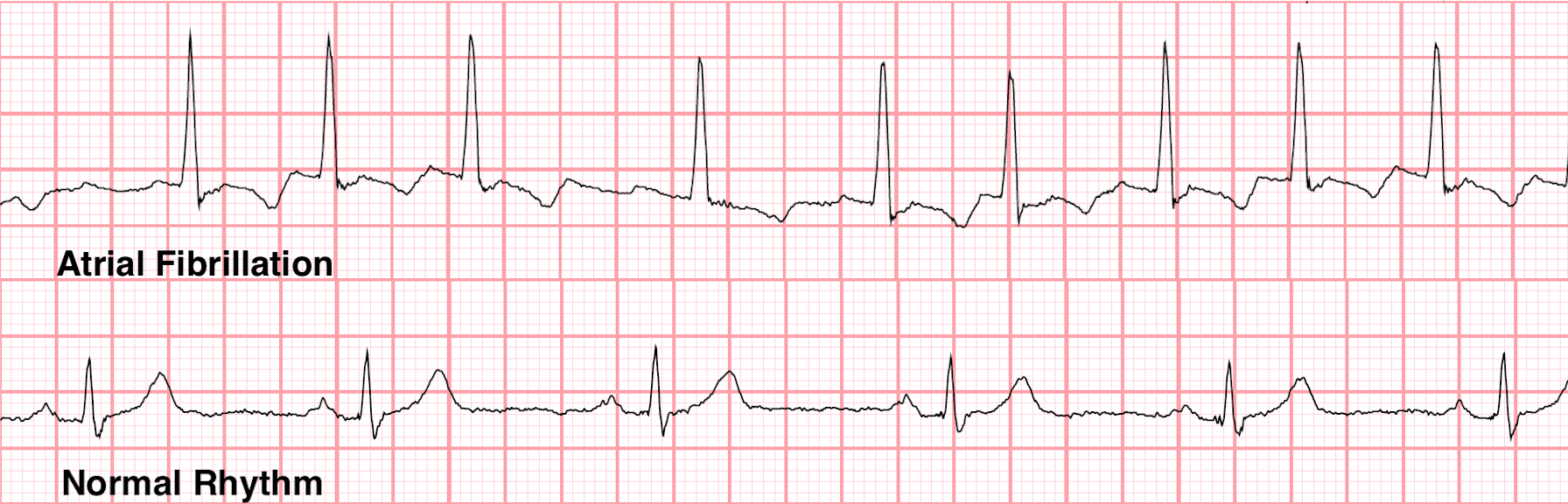 Atrial Fibrillation Dr Mark Perrin